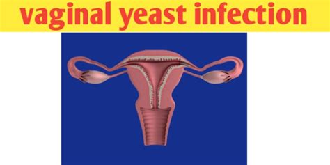 Vaginal Yeast Infection Causes Symptoms Discharge
