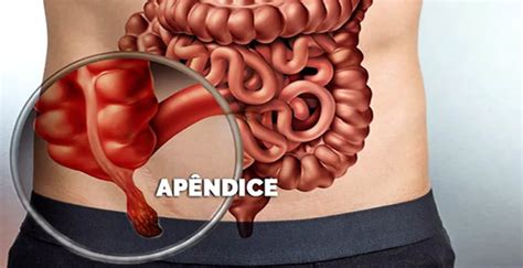 apendicite o que é causas sintomas tratamento