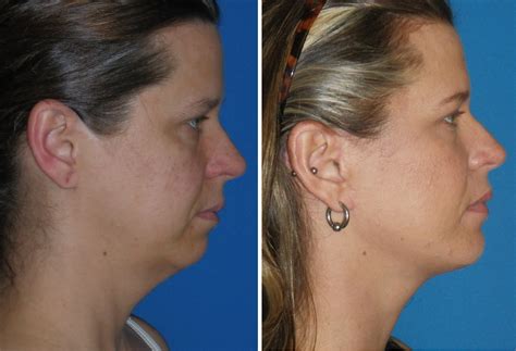 chin implants  fastest growing cosmetic surgery procedure