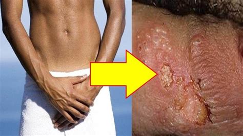 how to get rid of yeast infection in men