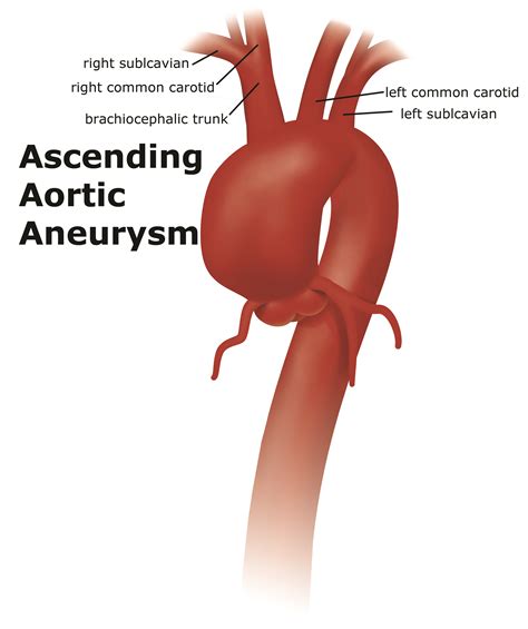 aneurysm endovascular treatment  intracranial aneurysms
