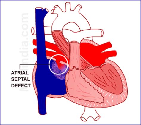 congenital heart disease septal defects atrial septal defect