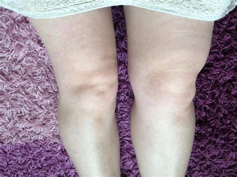 weird swelling above my knee mumsnet