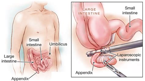 How To Shorten Appendectomy Recovery Time New Health Advisor