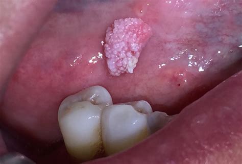 lesioni hpv correlate del cavo orale attualita  tema