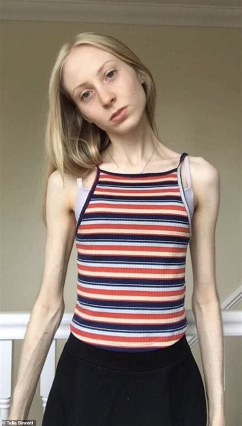 Anorexic 21 Praises All You Can Eat Buffets For Helping Her Recovery