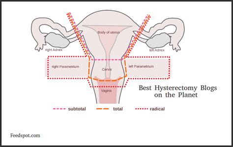 top 10 hysterectomy blogs and websites life after