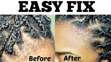 easy fix hairlineedges box braids twists youtube