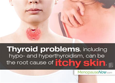 thyroid and itchy skin the link menopause now