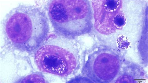 bacteria discovered  cookeville  battle cancer