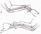 Forearm Volar Apex Angulation Fractures Deformity Mechanism Reduction Casting Closed Supination sketch template