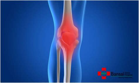 Knee Replacement Surgery Know The Complications
