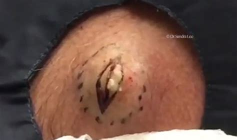 graphic content sickening video shows three giant cysts