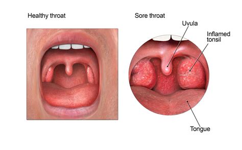 Sore Throat Antibiotic Use Cdc