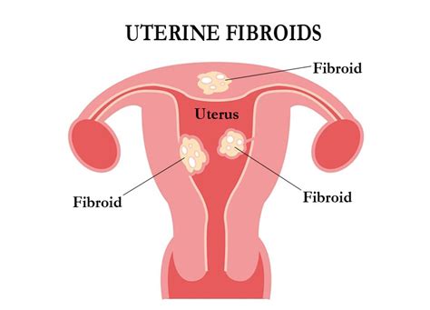 Uterine Fibroids Health Pages Romwell Internet Guide