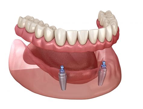 prothese sur implant  besancon dr valentin loriod