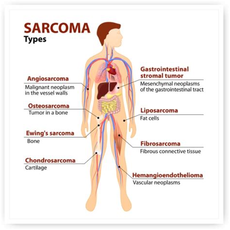 Sarcoma Lakeshore Cancer Center