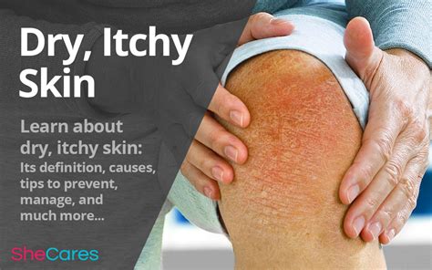 Dry Itchy Skin Shecares