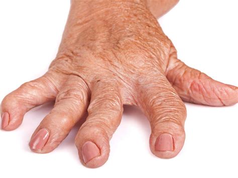 rheumatoid arthritis pictures symptoms   joints