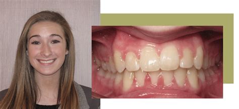 before and after andover orthodontics in andover ma