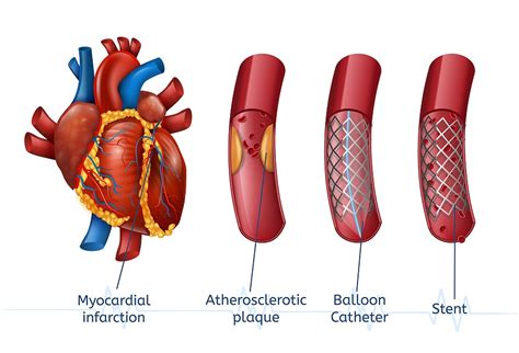cardiologist suggested      stent