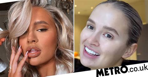 Molly Mae Hague S Lips Have ‘stretched’ After Having Fillers Dissolved