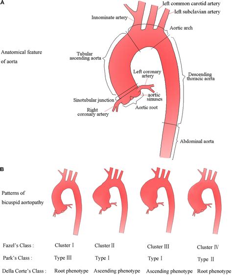 ascending aortic dilatation   bicuspid aortic valve
