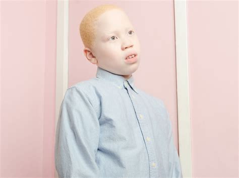 Albinism In Humans Pictures – 26 Photos And Images