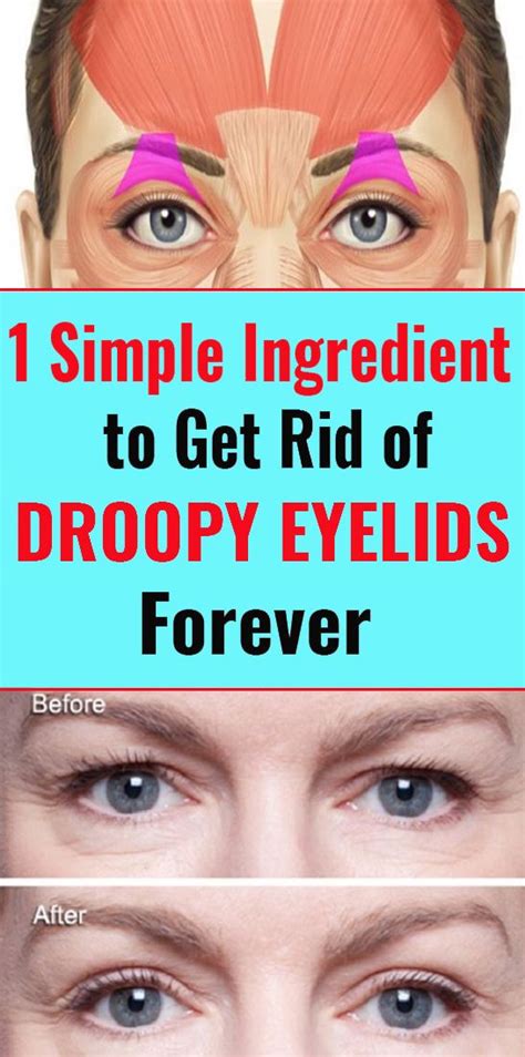 One Simple Ingredient To Get Rid Of Droopy Eyelids Forever Droopy