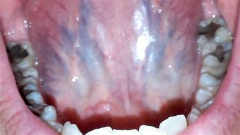 purple tongue  including spots  tongue veins bumps