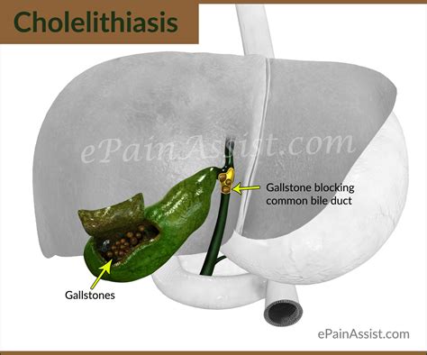 Cholelithiasis Types Causes Signs Symptoms Treatment