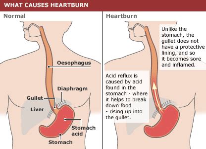 acid reflux ent clinic sydney