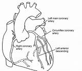 Coronary Arteries Artery Angiogram Stent Angioplasty Circulation Veins Pci Darah Aliran Medication Discharge Insertion Nhs Clipartxtras sketch template