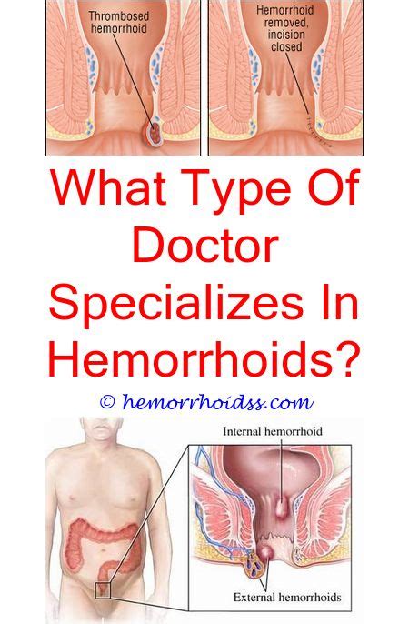 prodigious ideas what dr do you see for hemorrhoids can you have