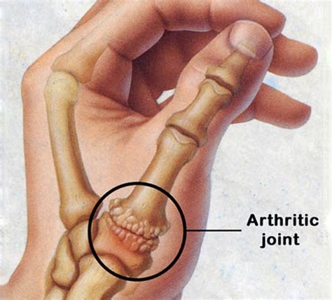basal thumb arthritis treatment  provide pain relief modern