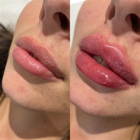 lip filler treatments in essex look aesthetics