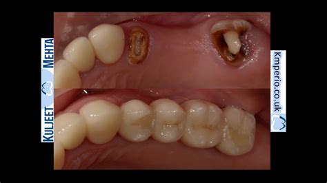 dental implants  replace upper left  teeth youtube