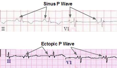 ectopic atrial rhythms ecg review criteria  examples