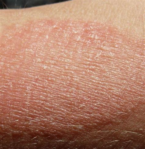 dry skin patches causes symptoms diagnosis and treatments