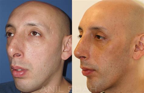 Facial Implants Photos Chicago Il Patient 415