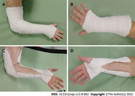 short arm cast   effective  long arm cast  maintaining distal