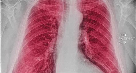 Pictures Of Lungs With Copd What Chronic Obstructive Pulmonary Disease