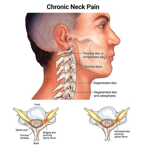 chronic neck pain     njs top orthopedic