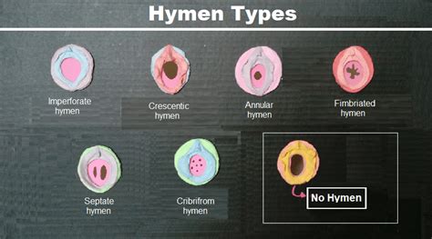 Hymen Types Shapes And Sizes Archives Helal Medical