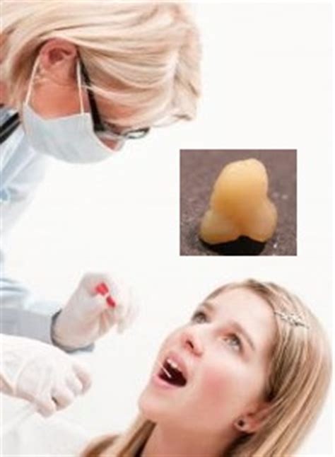 oorzaken witte stukjes  de keel hoe krijg je amandelstenen amandelstenen top