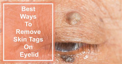 best ways to remove skin tags on eyelid [100 working]