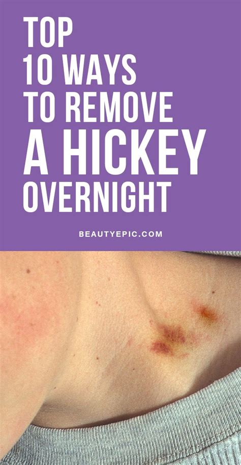 top 10 easy ways to get rid of a hickey overnight how to hide hickeys hickey cover up hickey