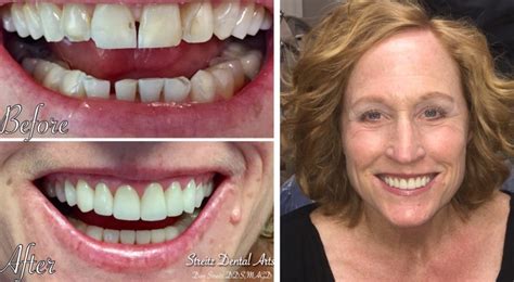 Dental Implants Before And After Favourite Dentistry