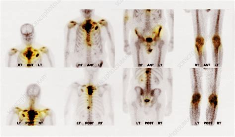 Bone Scan Showing Multiple Metastases Stock Image C027 1195