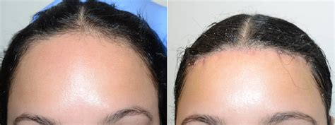 Hair Transplants For Women Pictures Miami Fl Paciente 117260